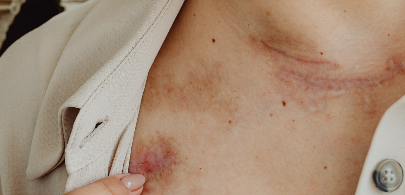 Edema