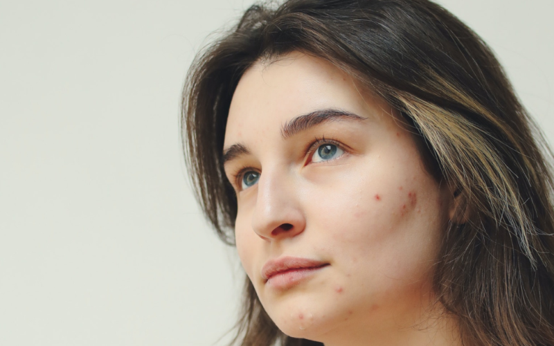 7-possible-reasons-behind-your-pimples