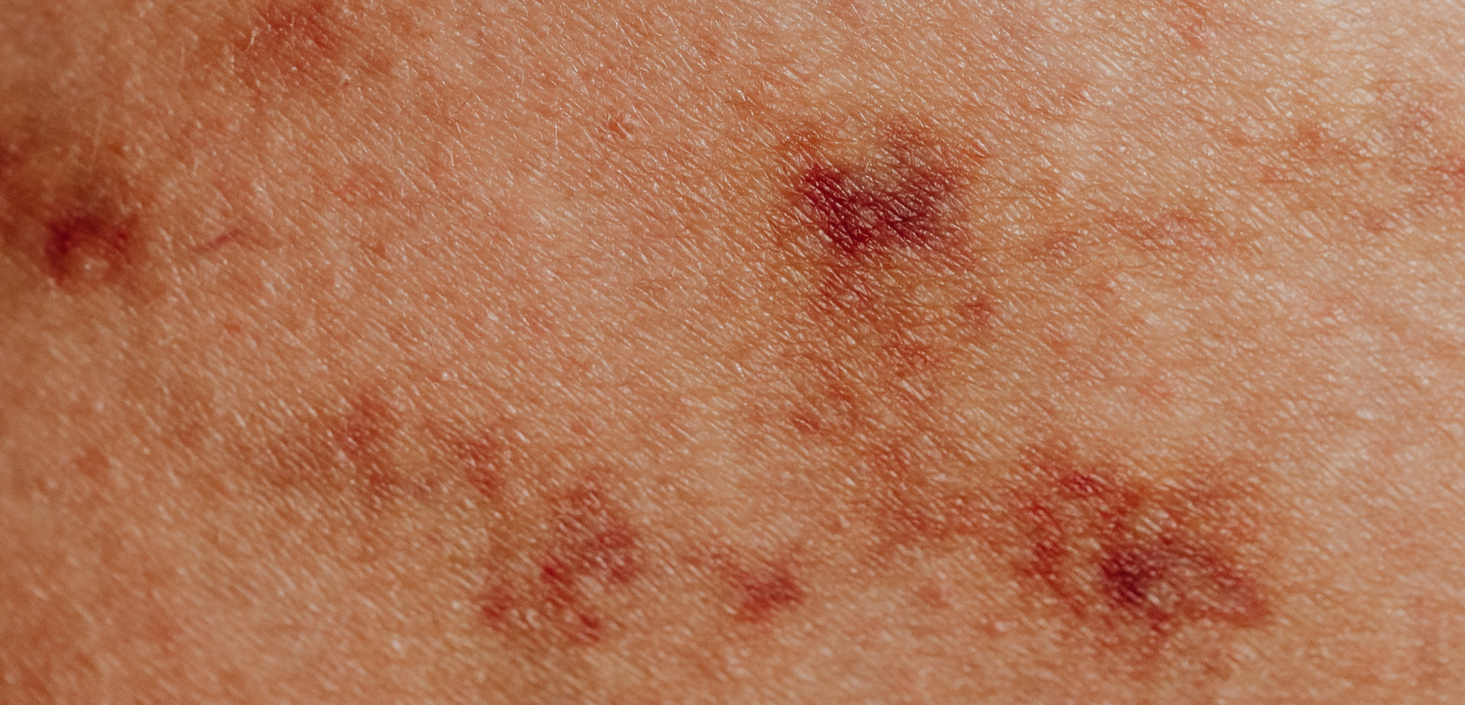 infections
