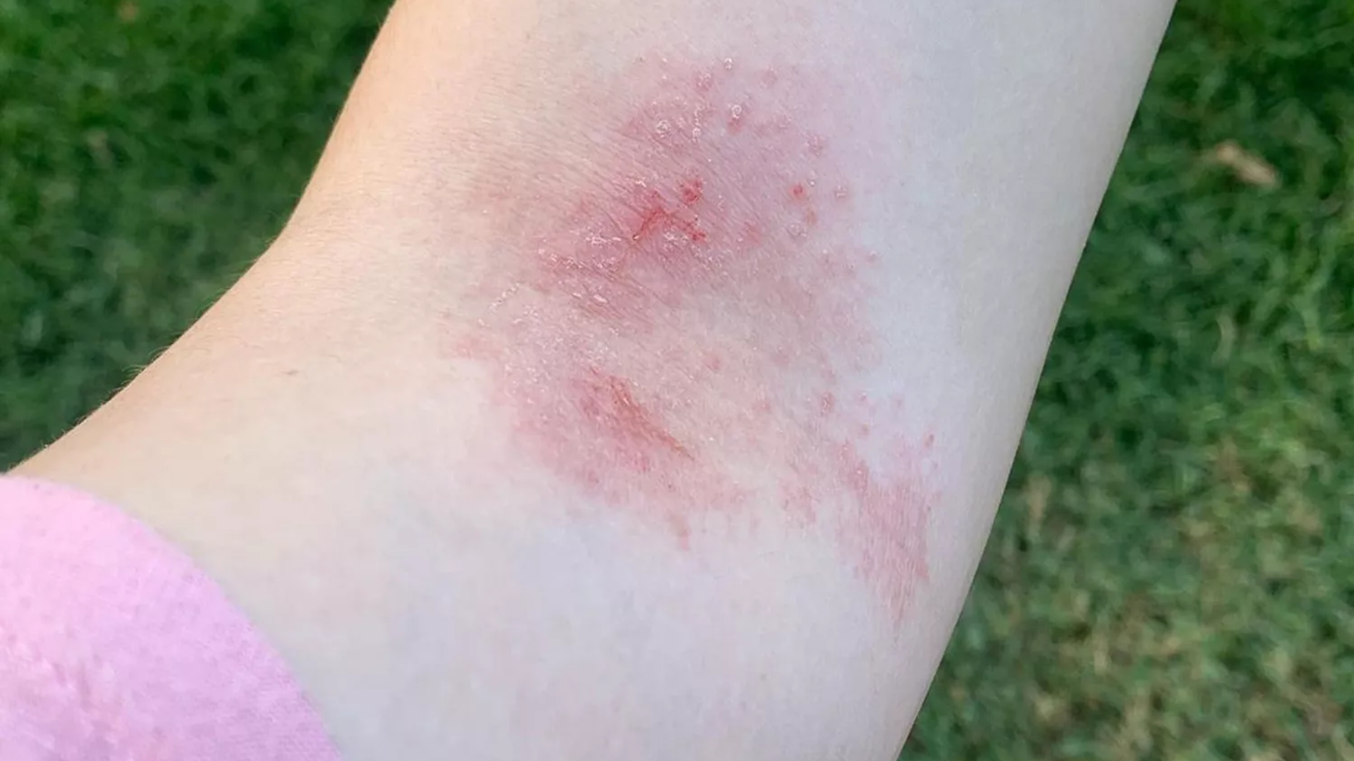 Woman, 25, has rare allergy, her scalp bleeds while showering 2 Water Allergy 1